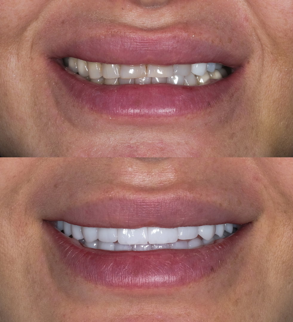 dental-bonding-near-me4