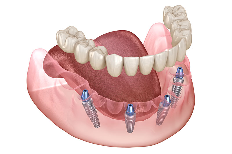 All-on-4 Dental Implants in Panama City