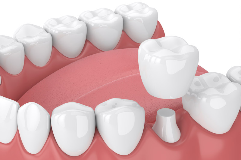 Dental Crowns in Panama City
