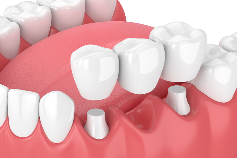 Dental Bridges in Panama City