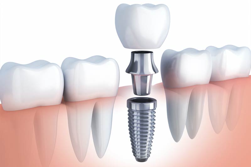 Dental Implant Restoration in Panama City