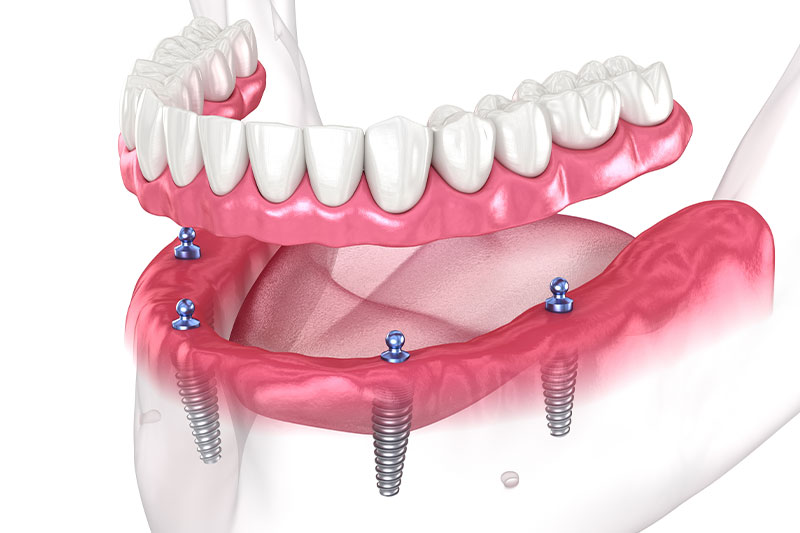 Implant Supported Dentures in Panama City