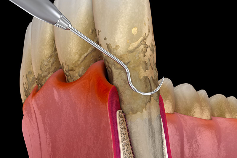 Periodontal Treatment in Panama City