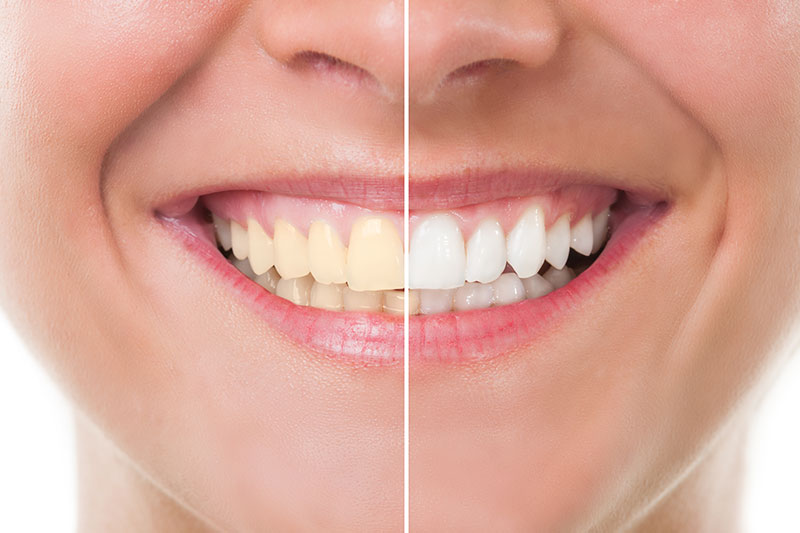 Teeth Whitening in Panama City