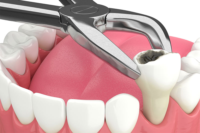 Tooth Extraction in Panama City