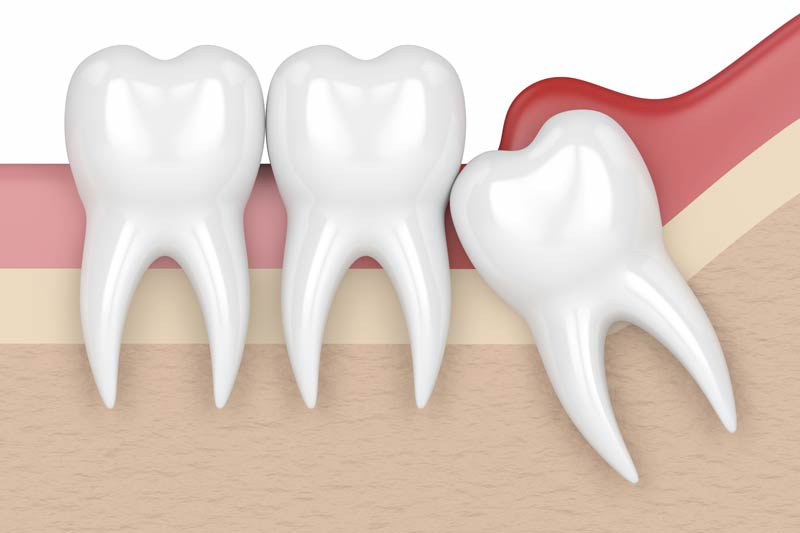 Wisdom Tooth Removal in Panama City